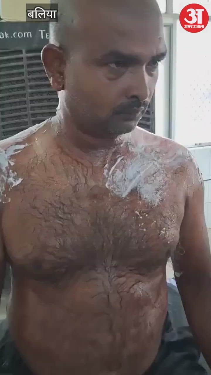 Boiling oil thrown on younger brother due to family dispute