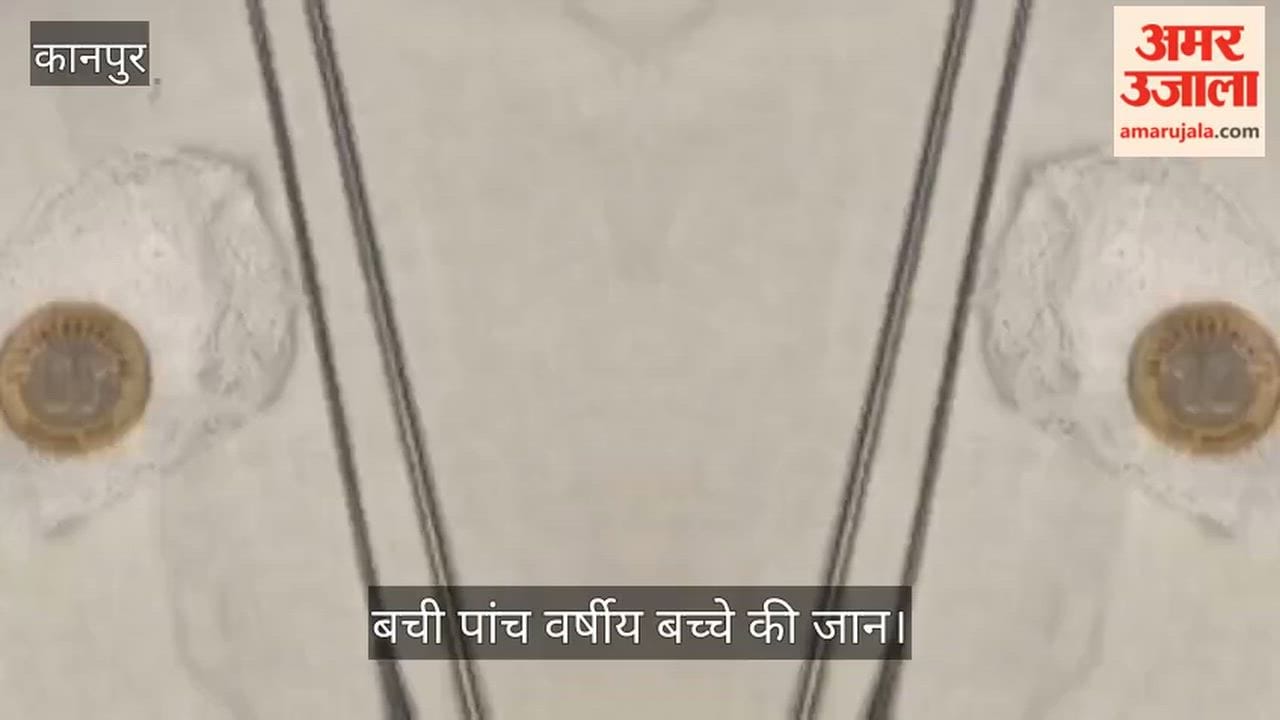 Kanpur Doctors at Hallet Emergency extract 10 rs coin stuck in child throat in just one minute